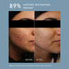 ACNE ESSENTIALS DUO