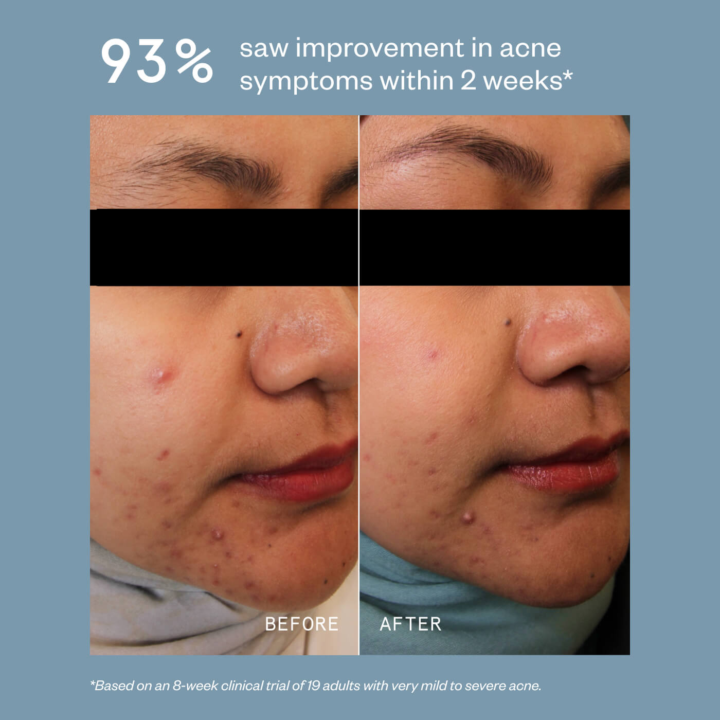 ACNE PRECISION SERUM