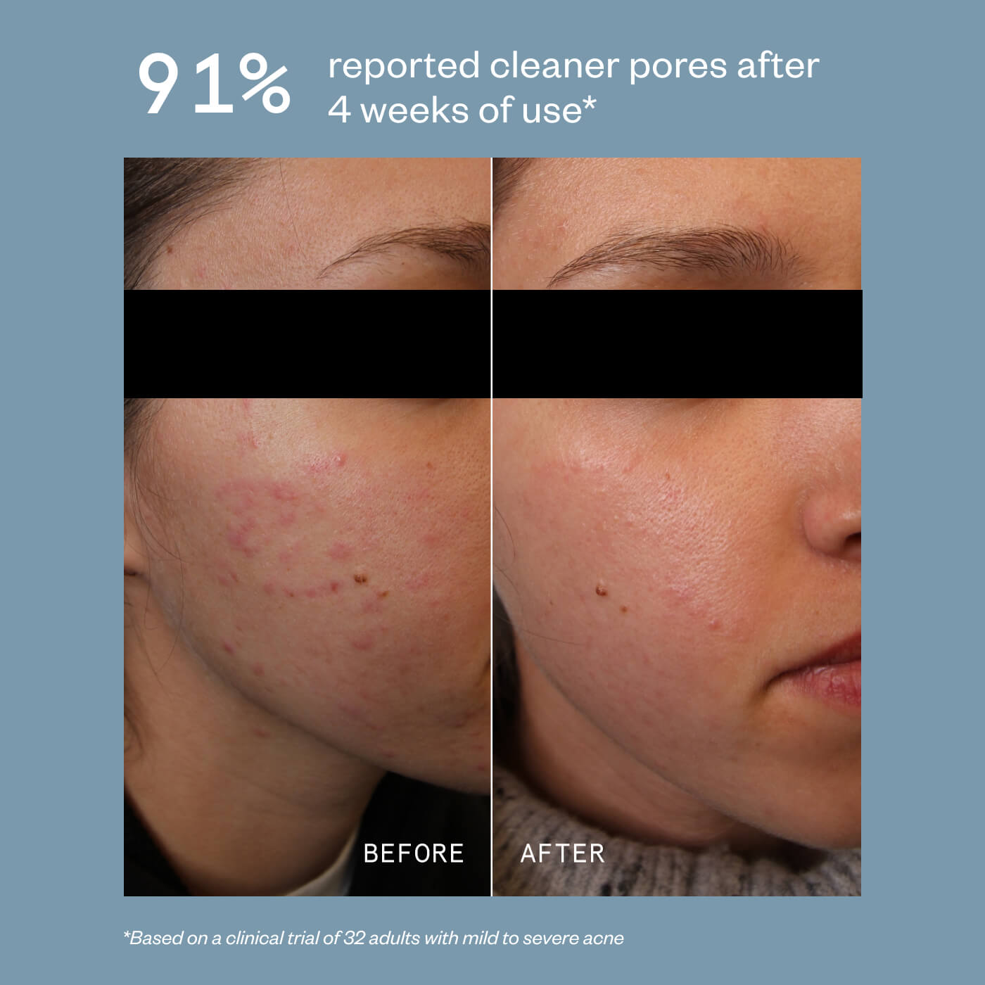 DAILY ACNE CLEANSER