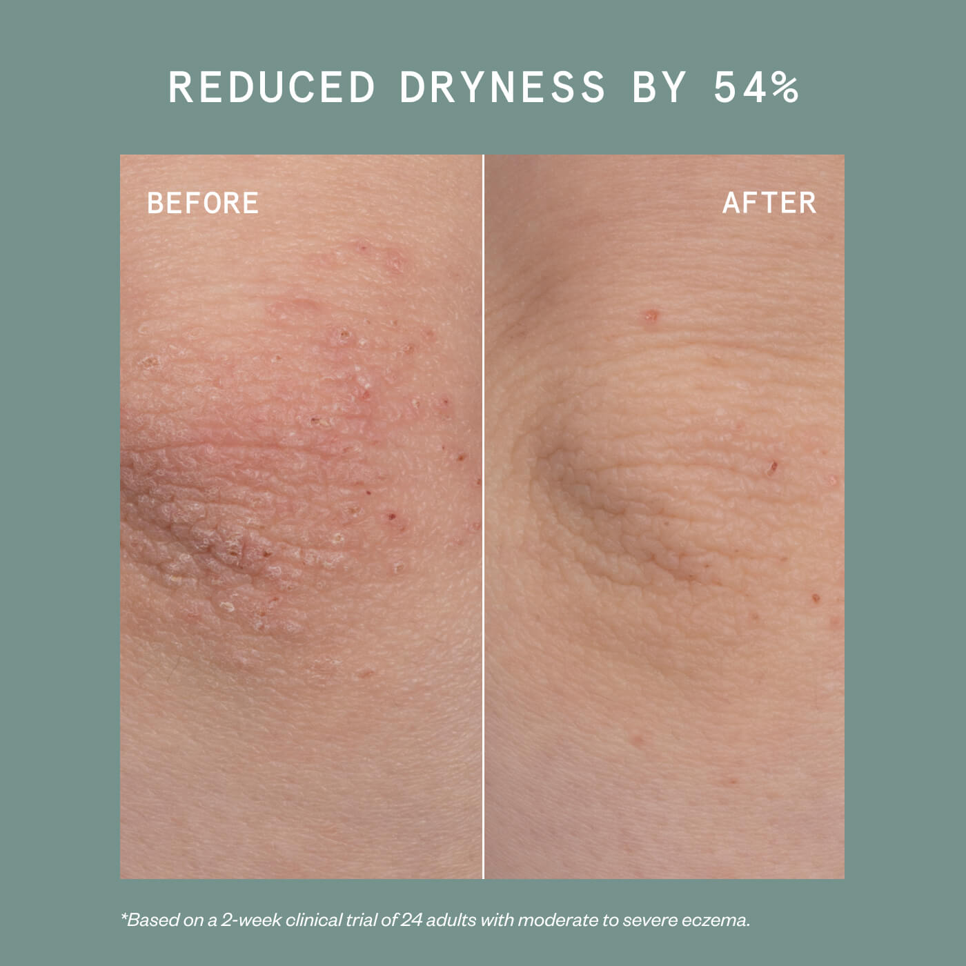 Eczema Travel Trio
