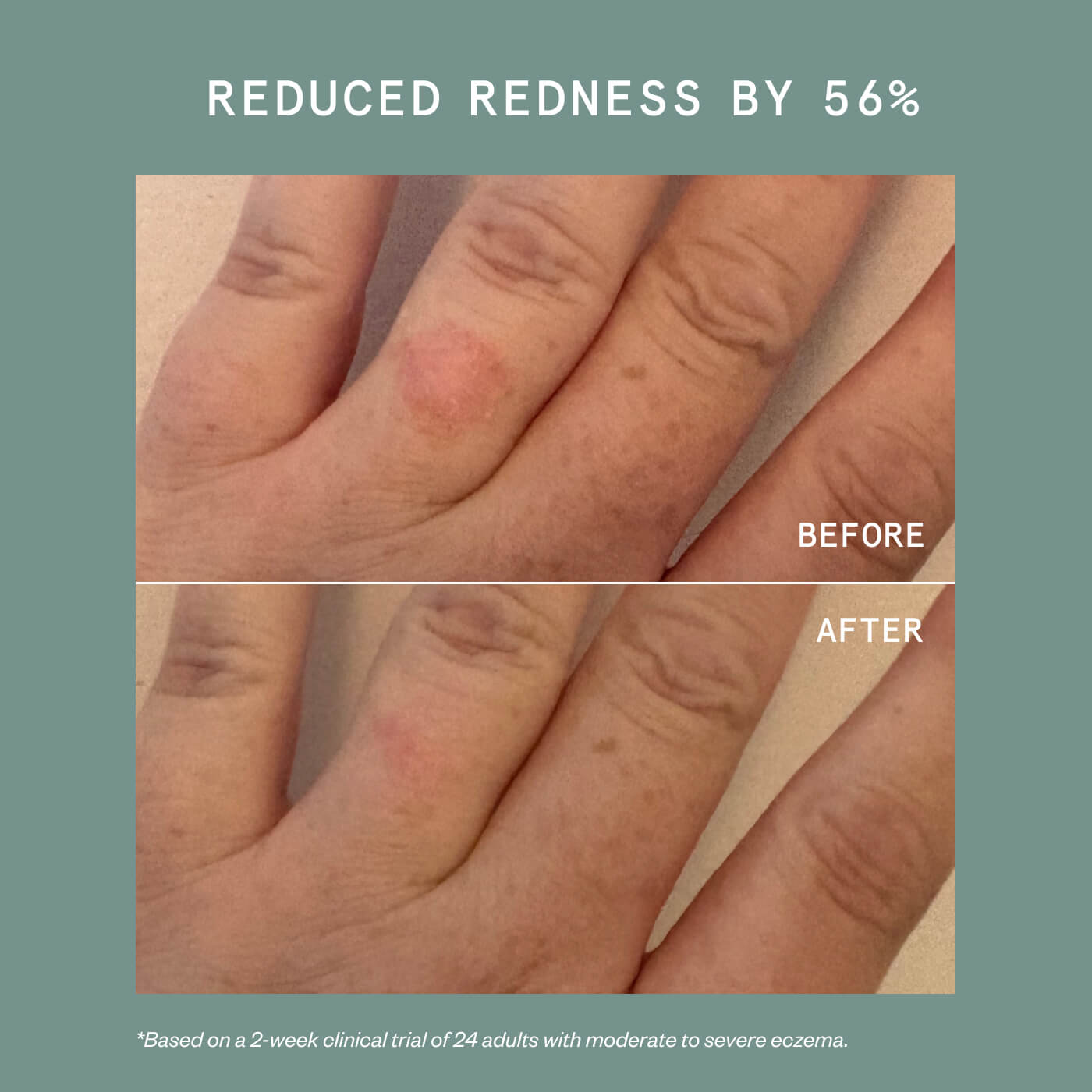 Eczema Travel Trio